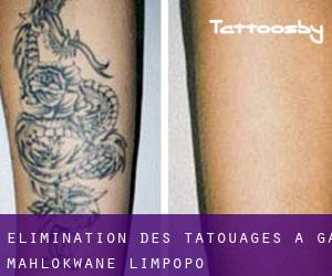 Élimination des tatouages à Ga-Mahlokwane (Limpopo)