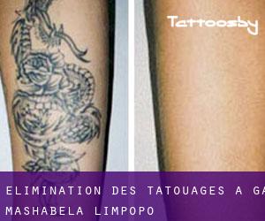 Élimination des tatouages à Ga-Mashabela (Limpopo)