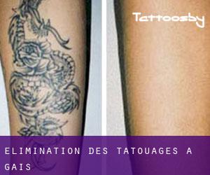Élimination des tatouages à Gais