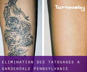 Élimination des tatouages à Gardendale (Pennsylvanie)