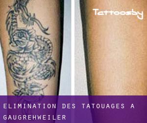 Élimination des tatouages à Gaugrehweiler