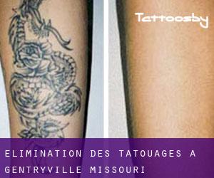 Élimination des tatouages à Gentryville (Missouri)