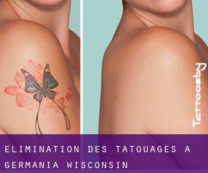 Élimination des tatouages à Germania (Wisconsin)