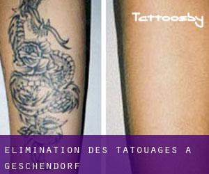 Élimination des tatouages à Geschendorf