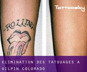 Élimination des tatouages à Gilpin (Colorado)