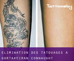 Élimination des tatouages à Gortakecran (Connaught)