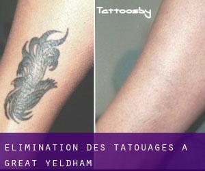 Élimination des tatouages à Great Yeldham