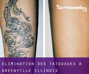 Élimination des tatouages à Greenville (Illinois)