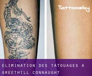 Élimination des tatouages à Greethill (Connaught)