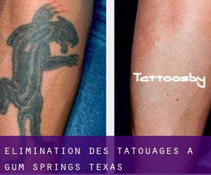 Élimination des tatouages à Gum Springs (Texas)