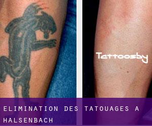 Élimination des tatouages à Halsenbach