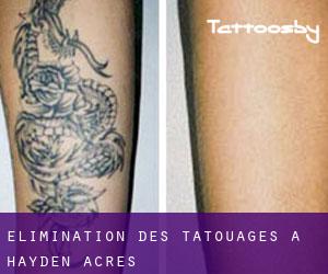Élimination des tatouages à Hayden Acres