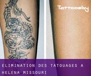 Élimination des tatouages à Helena (Missouri)
