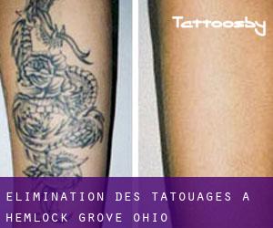 Élimination des tatouages à Hemlock Grove (Ohio)