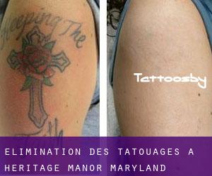 Élimination des tatouages à Heritage Manor (Maryland)