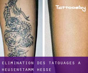 Élimination des tatouages à Heusenstamm (Hesse)