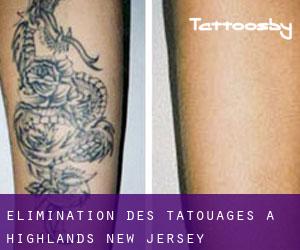 Élimination des tatouages à Highlands (New Jersey)