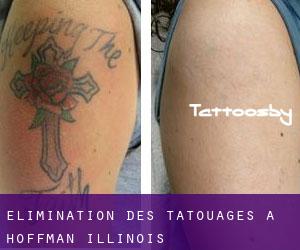 Élimination des tatouages à Hoffman (Illinois)