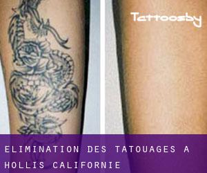 Élimination des tatouages à Hollis (Californie)