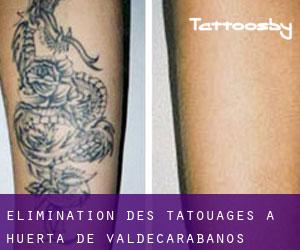 Élimination des tatouages à Huerta de Valdecarábanos