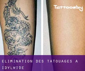 Élimination des tatouages à Idylwide