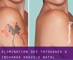 Élimination des tatouages à Inchanga (KwaZulu-Natal)