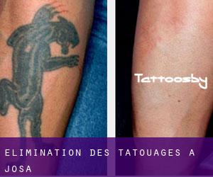 Élimination des tatouages à Josa