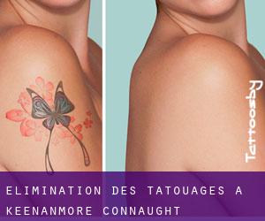 Élimination des tatouages à Keenanmore (Connaught)