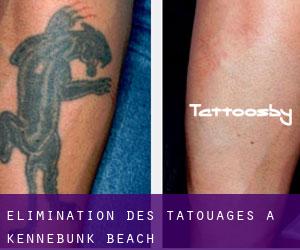 Élimination des tatouages à Kennebunk Beach