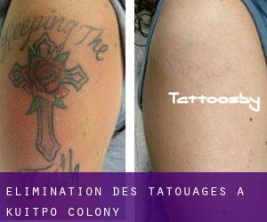 Élimination des tatouages à Kuitpo Colony