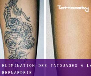 Élimination des tatouages à La Bernardrie