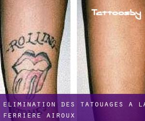 Élimination des tatouages à La Ferrière-Airoux