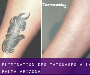 Élimination des tatouages à La Palma (Arizona)