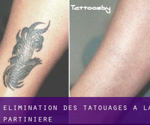 Élimination des tatouages à La Partinière