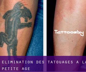 Élimination des tatouages à La Petite Age