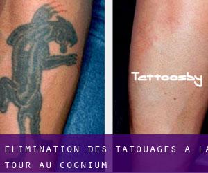 Élimination des tatouages à La Tour-au-Cognium