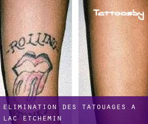 Élimination des tatouages à Lac-Etchemin