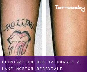 Élimination des tatouages à Lake Morton-Berrydale