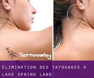 Élimination des tatouages à Lake Spring Land