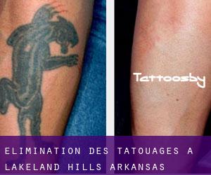 Élimination des tatouages à Lakeland Hills (Arkansas)