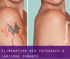 Élimination des tatouages à Larisons Corners