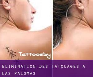 Élimination des tatouages à Las Palomas