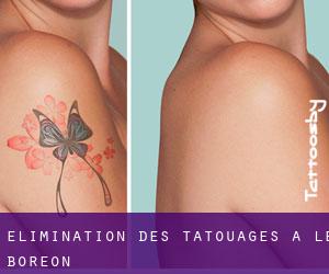Élimination des tatouages à Le Boréon