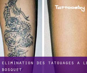 Élimination des tatouages à Le Bosquet