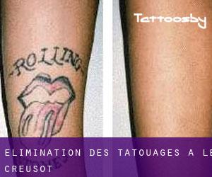 Élimination des tatouages à Le Creusot