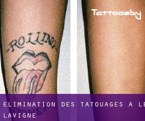Élimination des tatouages à Le Lavigne
