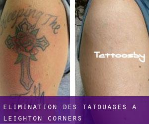Élimination des tatouages à Leighton Corners