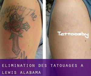 Élimination des tatouages à Lewis (Alabama)