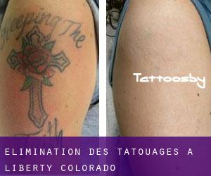 Élimination des tatouages à Liberty (Colorado)