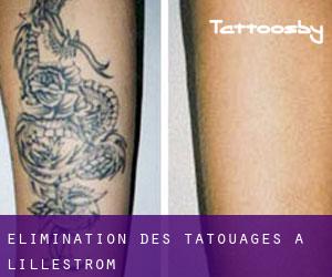 Élimination des tatouages à Lillestrøm